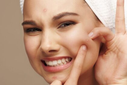 Egy fiatal nő, aki pattanást mutat az arcán, miközben mosolyog.