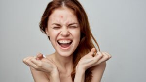 Egy fiatal nő mosolyogva, boldogan mutatja a kezét, miközben az arca egy mitesszertől szenved.