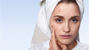 Fiatal nő, aki gyulladt pattanásokkal az arcán, törölközővel a fején, aggódva néz a kamerába.