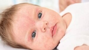 Egy kisbaba arca, piros foltokkal és bőrkiütésekkel, ami allergiás reakcióra utalhat.