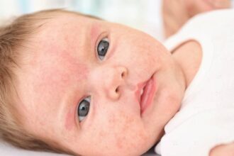 Egy kisbaba arca, piros foltokkal és bőrkiütésekkel, ami allergiás reakcióra utalhat.