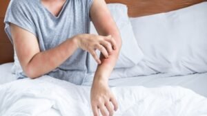 womensway 137 Egy ember karján piros, viszkető kiütések láthatók, ami ágyi poloska csípésére utalhat.