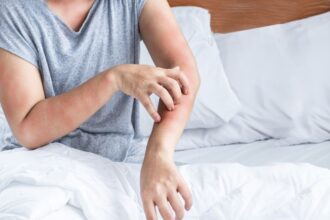 Egy ember karján piros, viszkető kiütések láthatók, ami ágyi poloska csípésére utalhat.