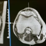 Térd MRI felvétel, a térd egészségének vizsgálatára